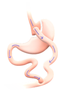 Gastric Bypass Icon