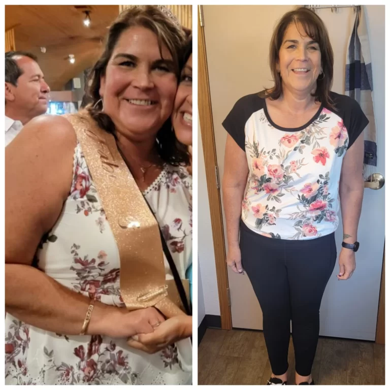 Bariatric Before and After_Sara W