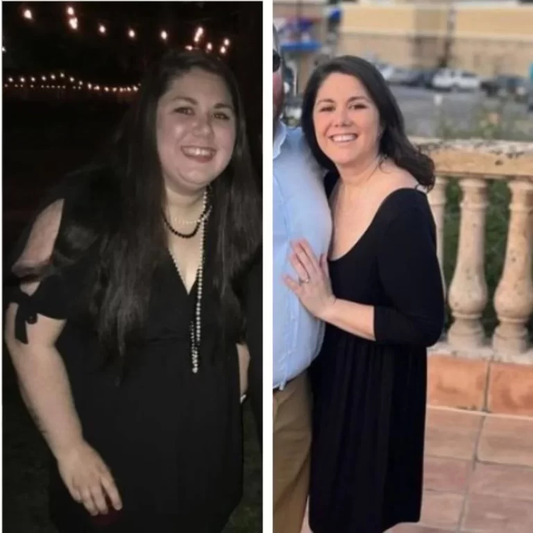 Bariatric Before and After_Sarah R